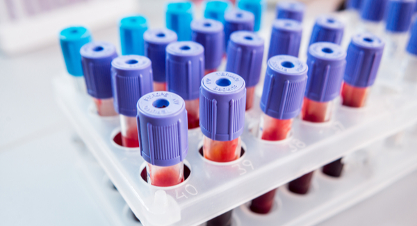 Blood, Fluid and Tissue Tests for Arthritis 