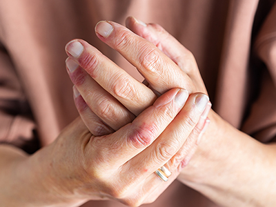 Psoriasis May Lead to Psoriatic Arthritis