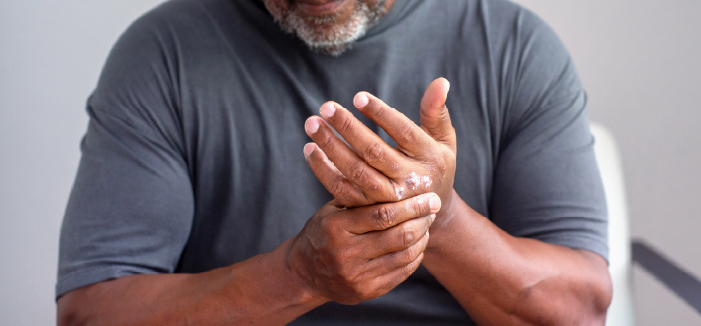 Psoriatic Arthritis Explained 