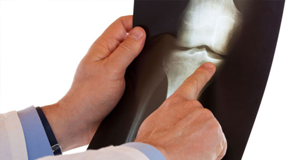 Is It Time for Joint Surgery?