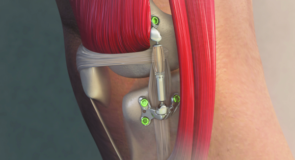 La FDA aprueba un nuevo implante para la artrosis​​​​​​​ de rodilla