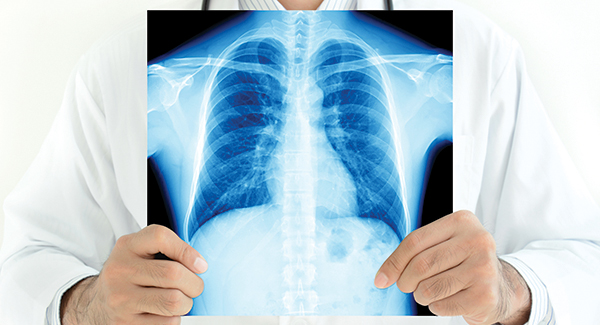 Lo que necesita saber acerca de la AR y la enfermedad pulmonar