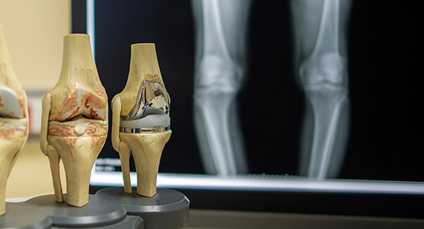 x-ray and models of the knee