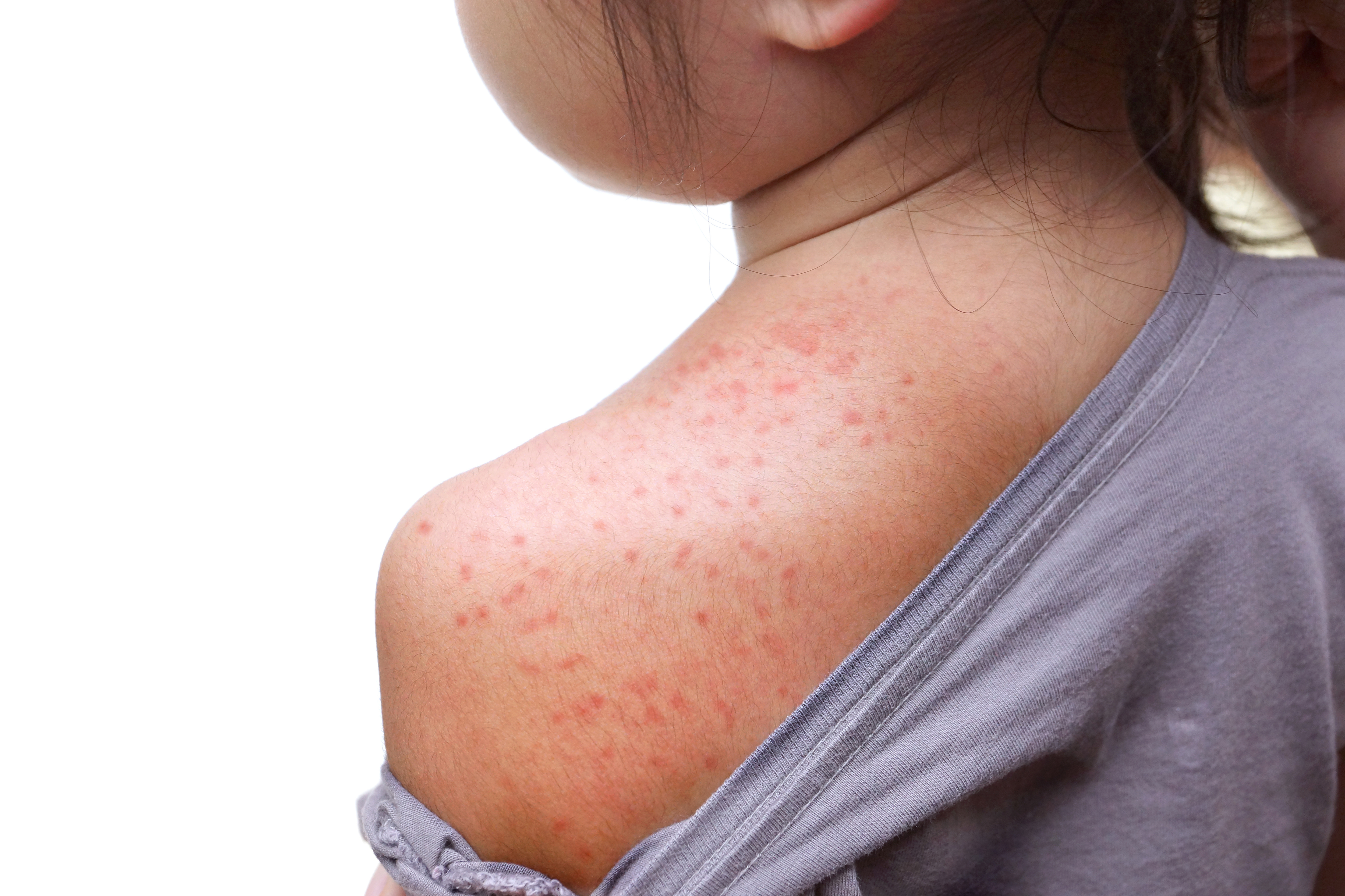 Juvenile arthritis-related rashes vary