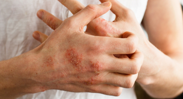Arthritis and Your Skin 